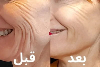 جوانسازی پوست صورت