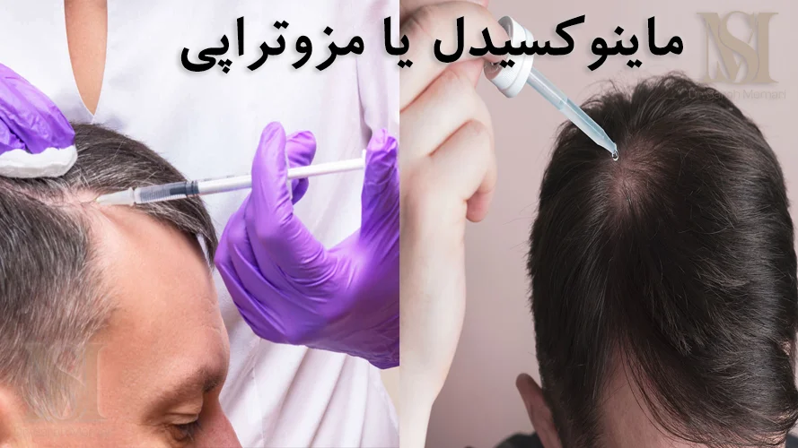 ماینوکسیدل یا مزوتراپی