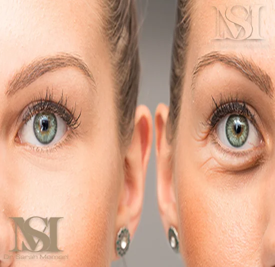 بلفاروپلاستی