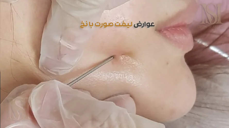 عوارض احتمالی لیفت صورت با نخ