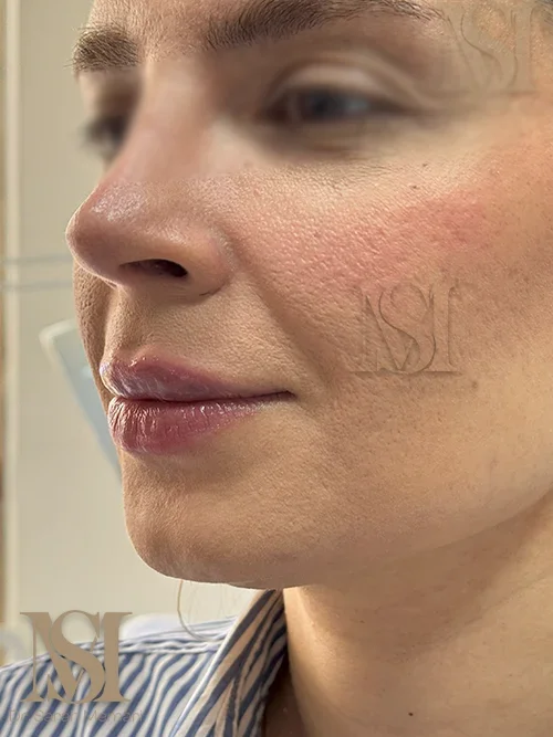 تزریق فیلر لب