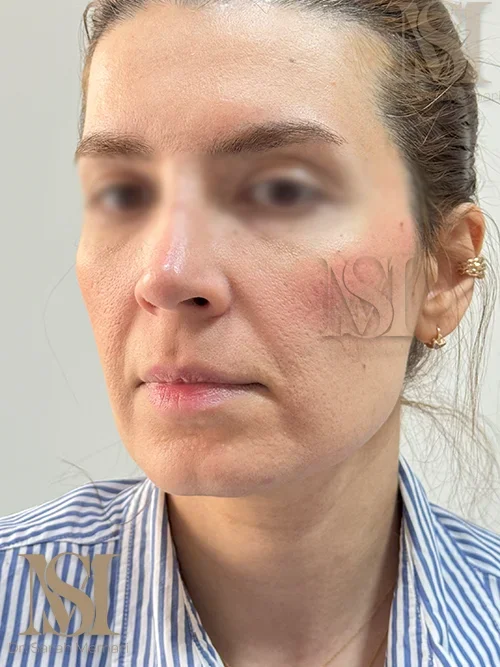 تزریق فیلر لب