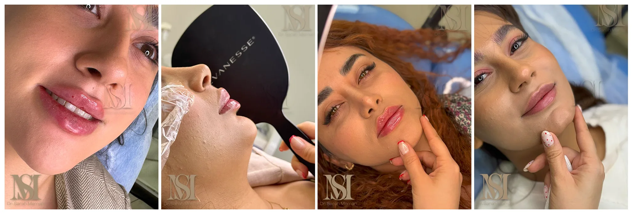 فیلر لب در کلینیک زیبایی دکتر معماری