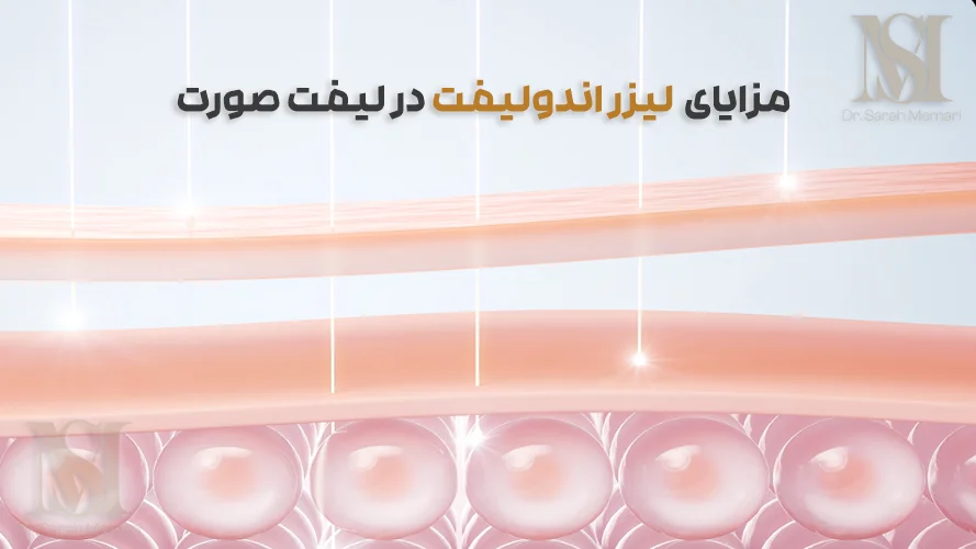 چرا لیزر اندولیفت انتخابی محبوب برای لیفت صورت است؟